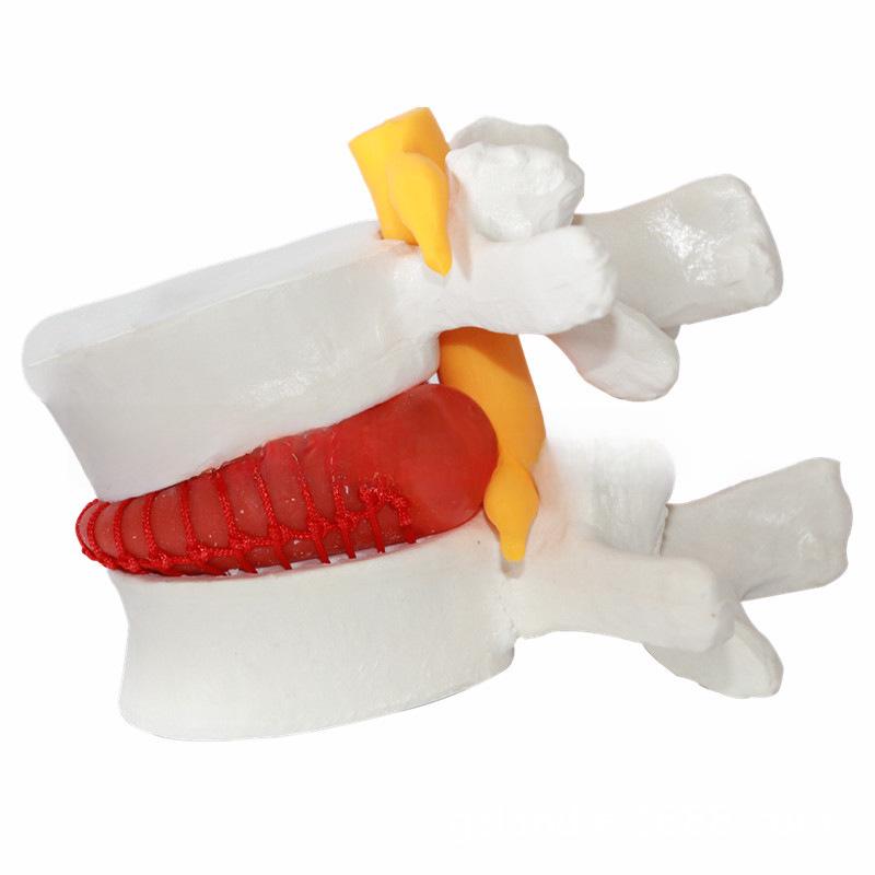 Genuine Lumbar Spine Protrusion & Vertebra Pathology Model