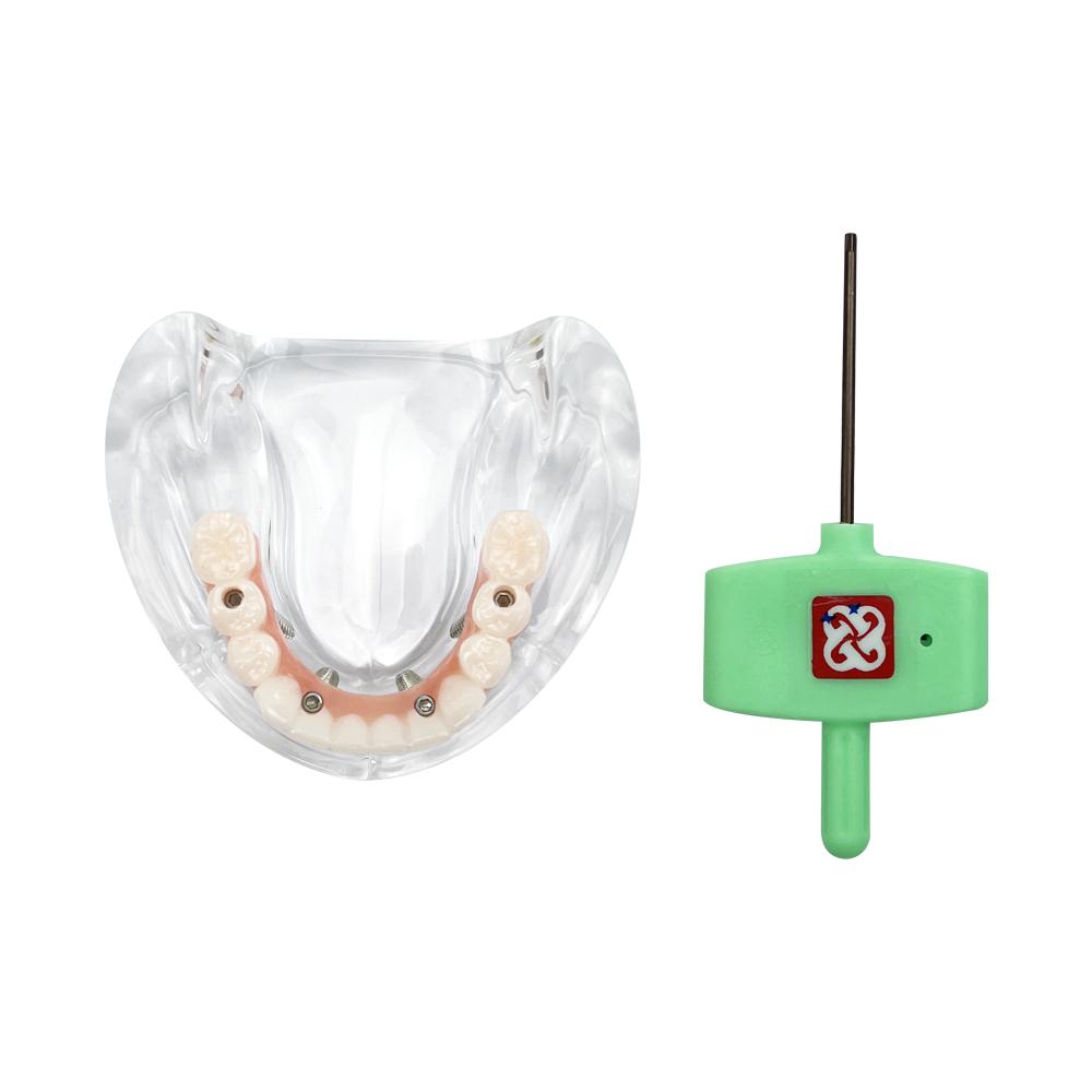 Dental Implant Model All On 4 Upper/Lower Jaw Dental Overdenture Teeth Model With Removable Recondition Implants For Education
