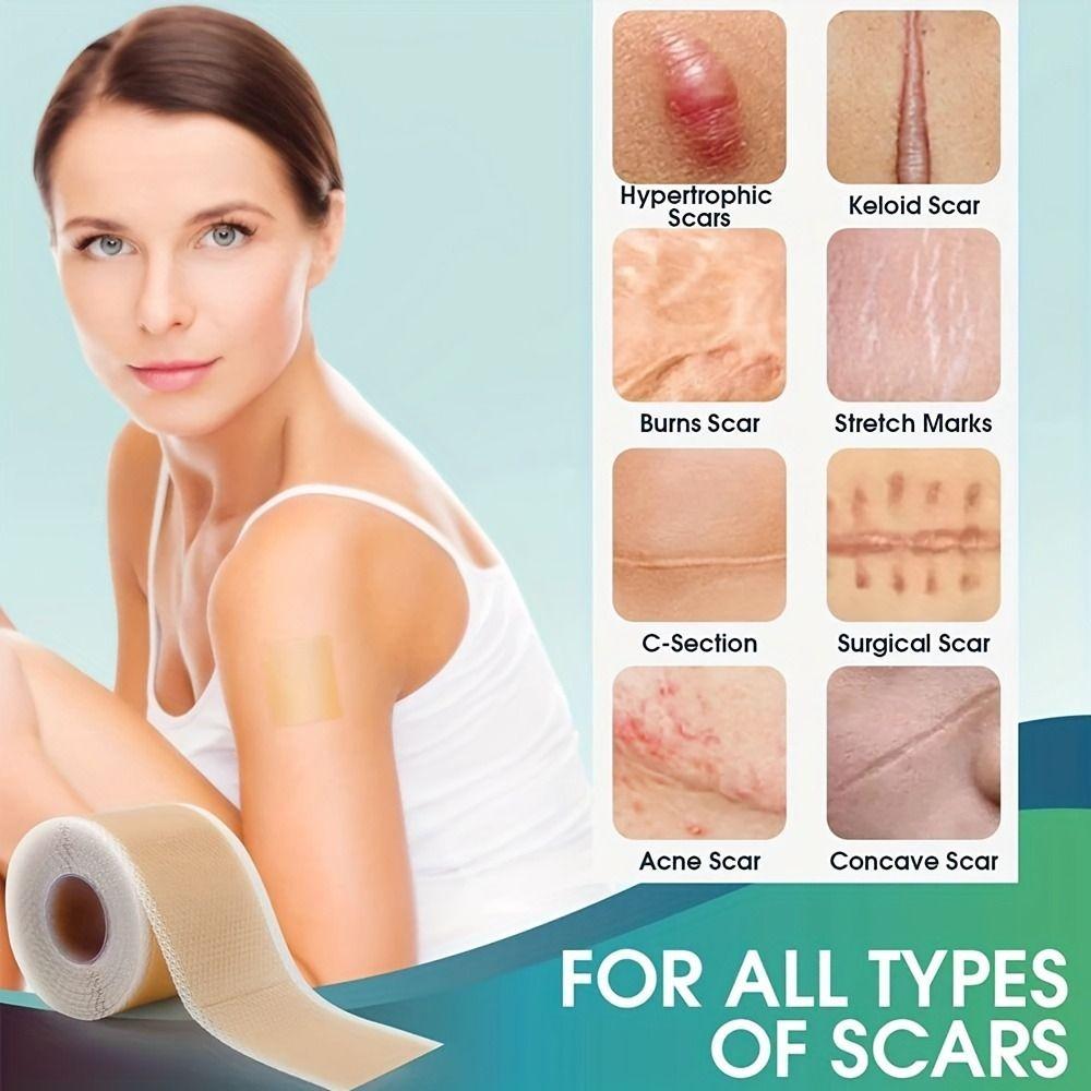 Self-Adhesive Scar Treatment Tape Easy-Tear Scar Care Patches Easy-to-Use Skin Cover Tape  Keloids