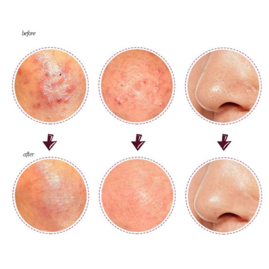 Edelstahl Pickel Akne Makel Komedonen Extraktor Mitesser Entferner Werkzeug