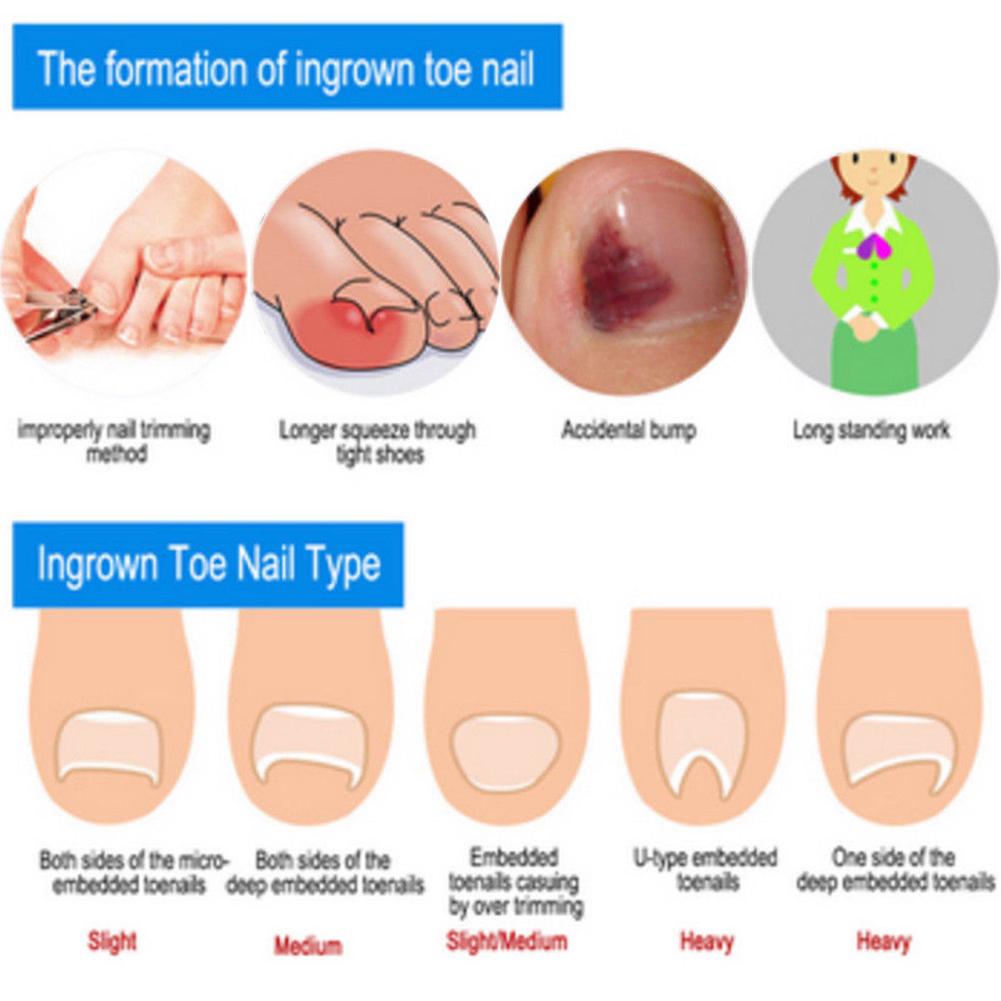 12 Pcs/box Ingrown Toe Nail Correction Pedicure Wire Fixer Paronychia Recover Tool