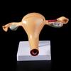Human Pathological Uterus Ovary Model Anatomical Anatomy Disease Pathology Medical Lesion Teaching