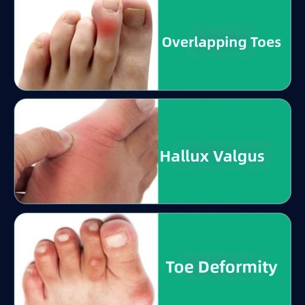 Adjustable Bunion Corrector Band Metal Reinforcement Foot Correction Brace Outdoor