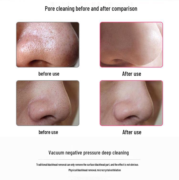 Hot Selling Blackhead Remover Pore Cleaner Beauty Set