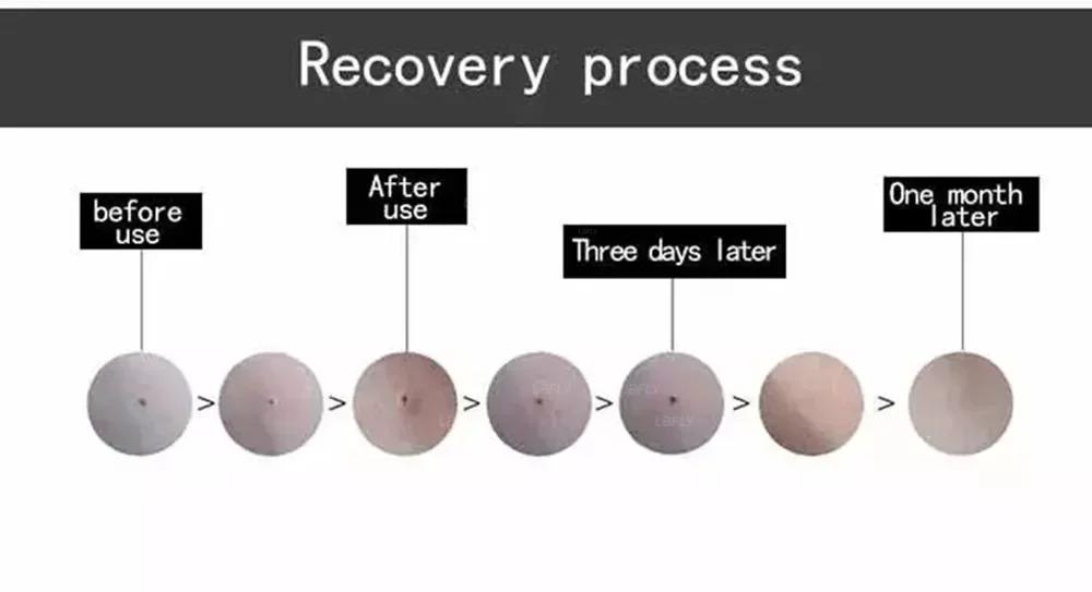 SPA Use Cold Plasma Pen Ozone Acne Remover Wrinkle Removal Skin Rejuvenation Sterilization Anti-inflammation Beauty Instrument