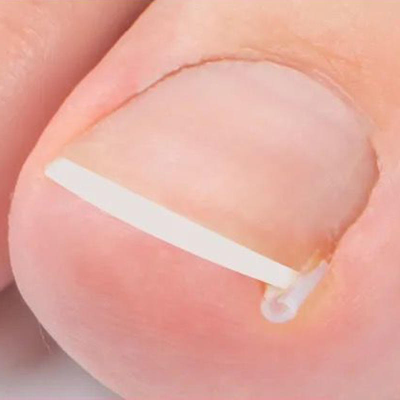 50PCS Ingrown Toenail Corrector Pads Kit Toenail Orthosis Corrector Strips Brace for Women Men