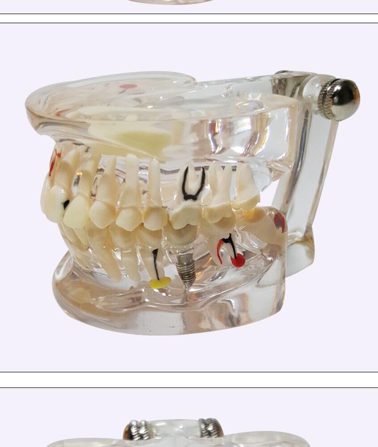 Human Tooth Anatomy Model for Teaching and Simulation - Detachable Denture Mold