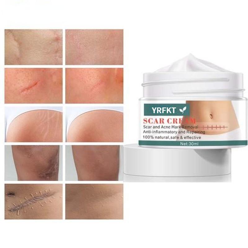 Cremă de întindere pentru cicatrici pentru acnee