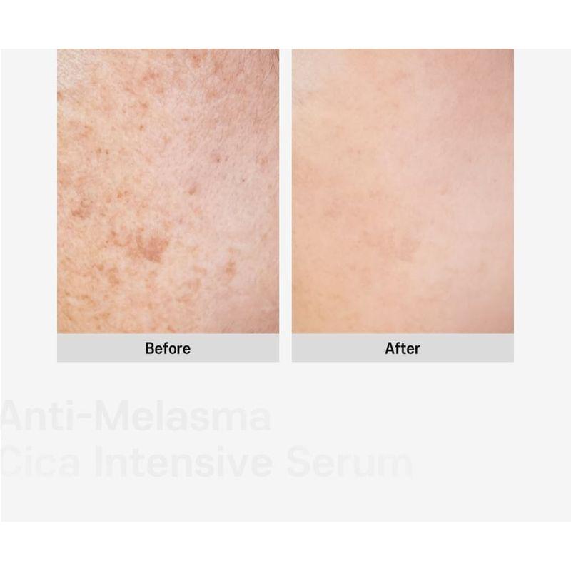 CARE:NEL - Anti-Melasma Cica Intensivserum