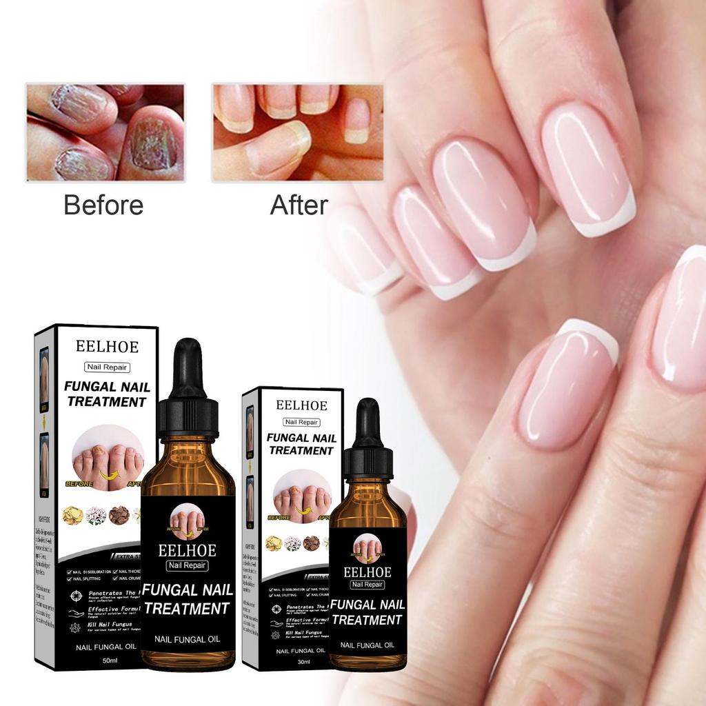 EELHOE Nail Repair Lotion – Brighten Nails, Remove Gray Nails, Repair and Moisturize, Nutritious Nail Care Solution