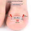 Ingrown Toenail Corrector Tools Pedicure Recover Embed Toe Nail Treatment Professional Ingrown Toenail Straightening Clip Brace