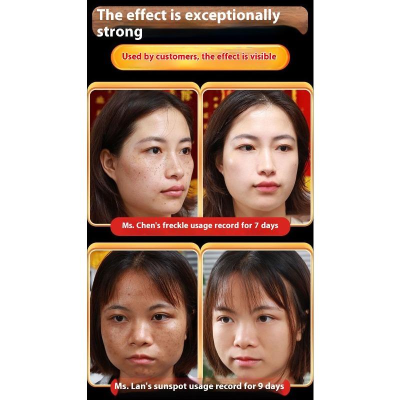 Whitening and Freckle Removing Cream Face Cream Lightening and Removing Spotles Sunburn Brightening Skin Color