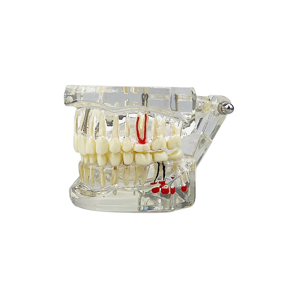 Transparent Dental Model Implant Restoration Bridge Tooth Disease Teaching Analysis Removable Teeth Demonstration Model белый