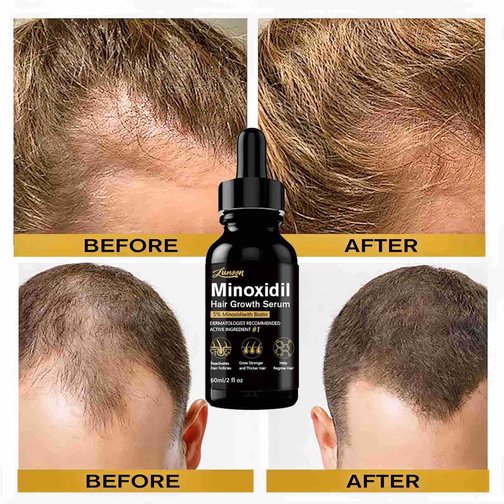 L'essence épaississante pour cheveux favorise la force des cheveux pour hommes et femmes, liquide nourrissant anti-chute et croissance des cheveux 60 ml
