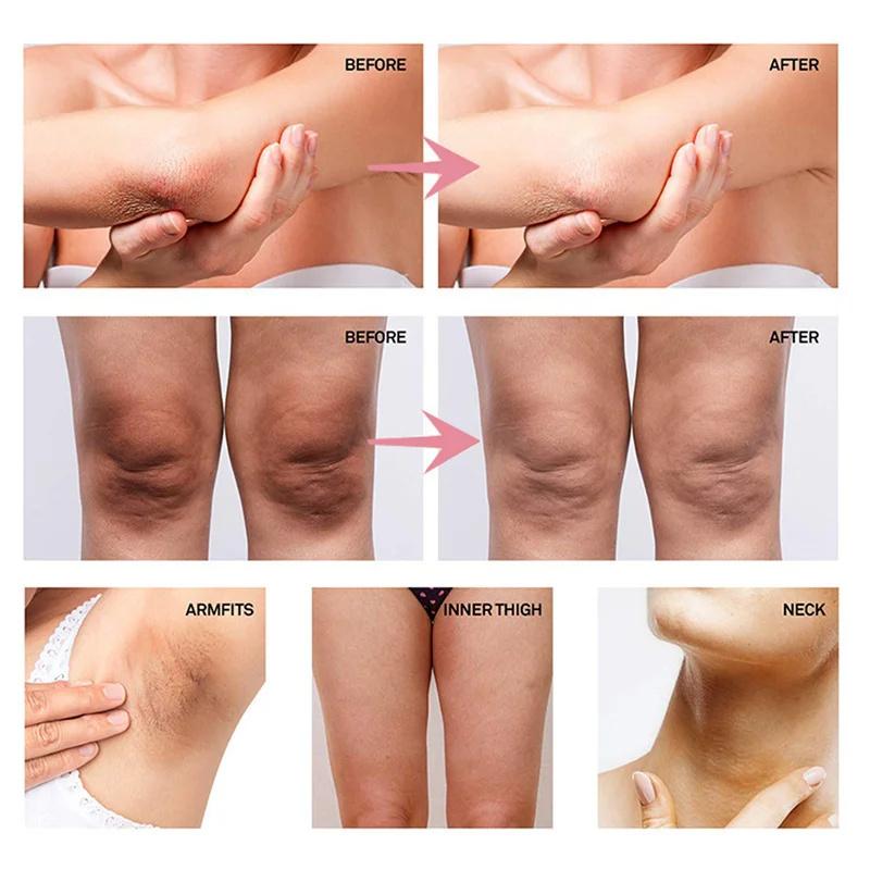 Aufhellungscreme, private Teile, Achsel-Bleaching-Serum, Aufhellung des Gesäßes, Knie, Aufhellung der inneren Oberschenkel, intime Teile, dunkle Melanin entfernen