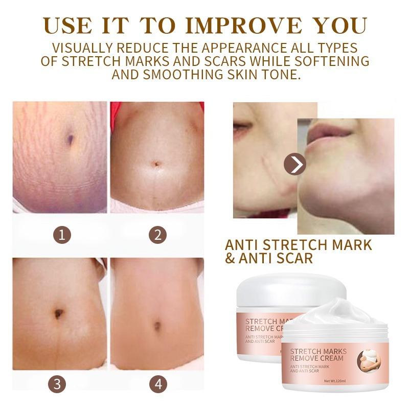 Private Label 100% Natural Vegan Effective Anti Postpartum Deep Acne Scar Skin Whitening Maternity  Removal Cream