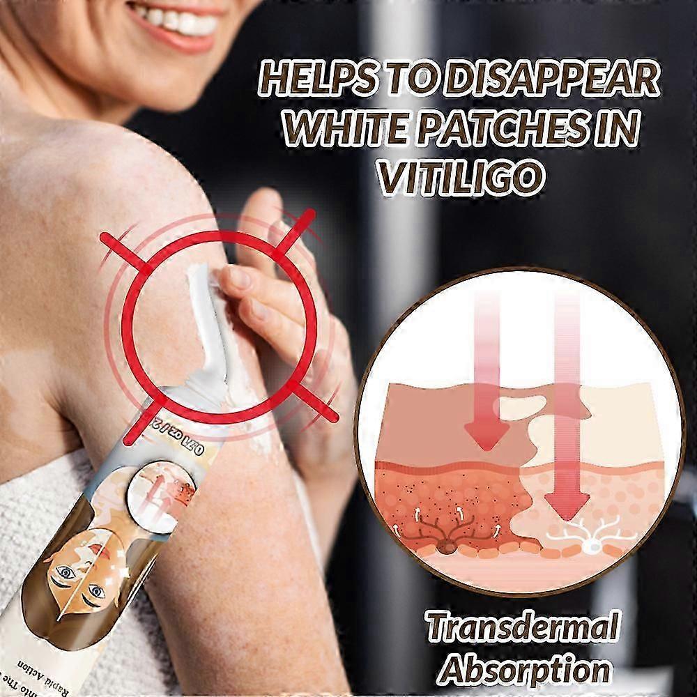 Vitiligo Cream, Anti-Vitiligo Cream, Reduce White Spots and Improve Skin Pigmentation, 20g