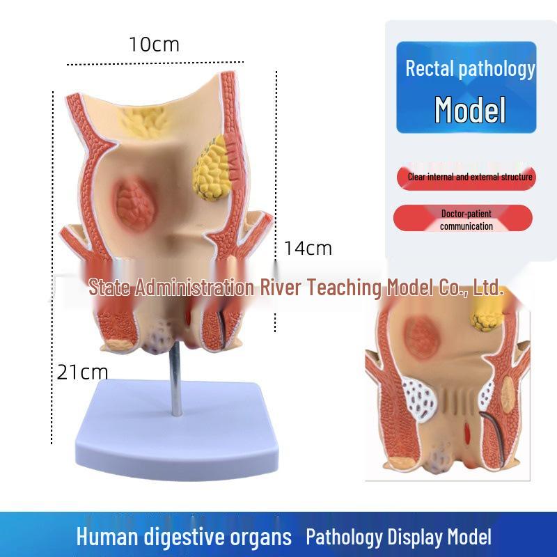 Large Intestine and Rectal Hemorrhoids Anatomy Model
