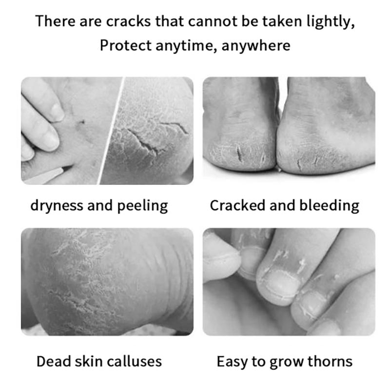 30/100Pcs Cracked Heel Hand Treatment Patches, Cracked Heel Hand Repair Bandage