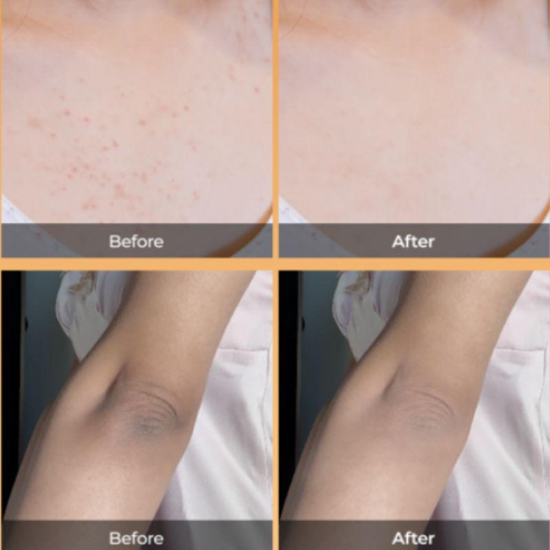 Dr. Melaxin Peel Shot Body Scrub Kojic Acid & Turmeric Peeling Spray 200ml – Exfoliating Body Peeling Spray for Smooth & Radiant Skin
