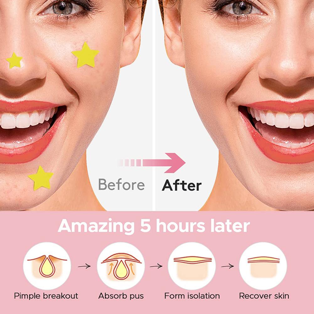 Renkli Sevimli Yıldızlar Kalpler Akne Sivilce Yamaları Örtücü Çıkartmalar, Görünmez Yüz Leke Sivilce Kapatıcı Makyaj Çıkartmaları