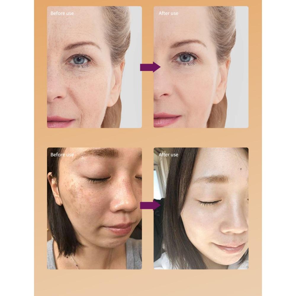 Gurkemeieessens lysner hudtonen og reduserer melasma