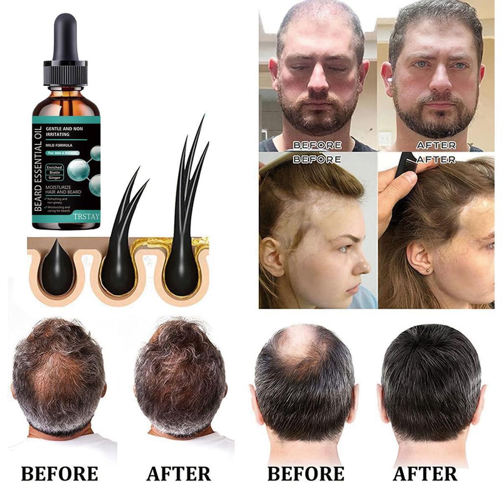 Saç Özü Yağı 5 Doğal Zencefil Saç Yağı Anti Saç Dökülmesini Önleme Kellik Tedavisi Hızlı Besleyici Saç Derisi Saç Bakımı