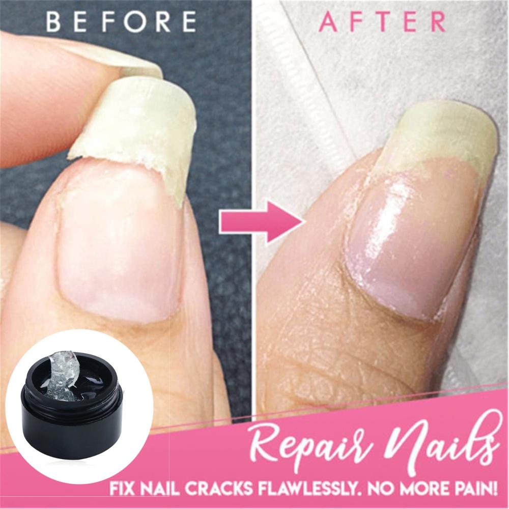 Ongle Cassé Récupération Ongle Fortifiant Ongle Fissures Réparation Ongle Gel Réparateur Instantané Ongle Fissuré