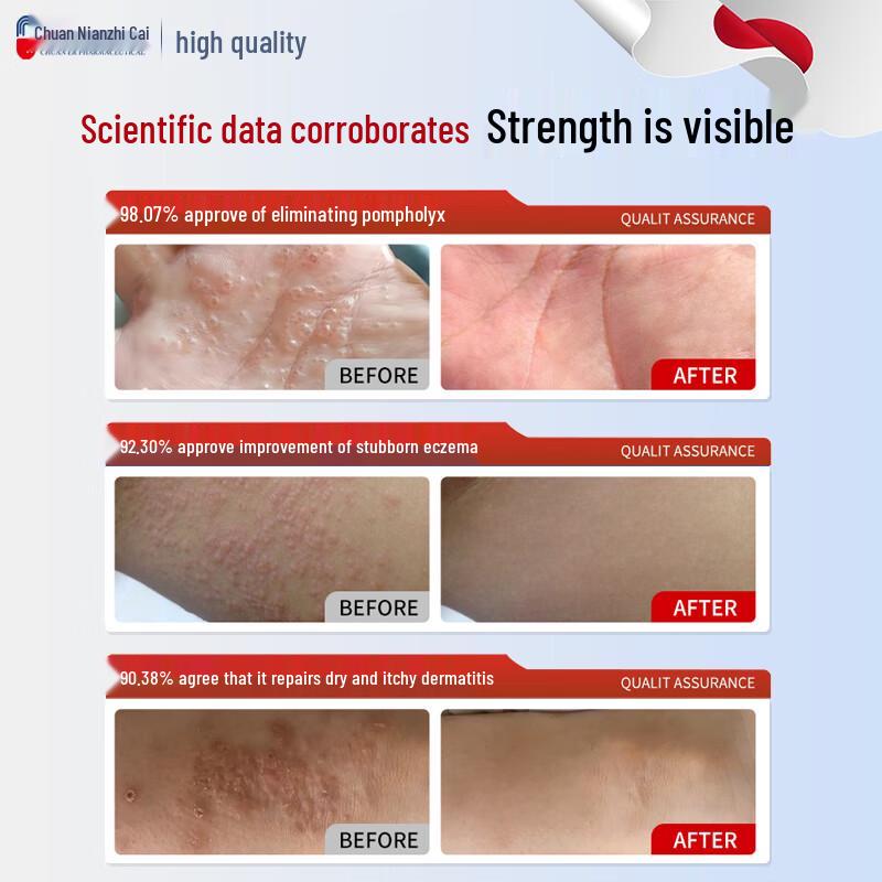 Chuan Nian Pompholyx & Eczema Relief Ointment
