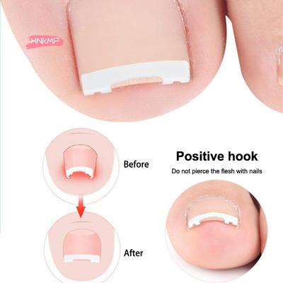 1 pièce Outil Professionnel Correcteur d'Ongle Incarné de Pied Pédicure Traitement des Ongles de Pied Soin des Pieds Kit de Récupération des Ongles Incrustés