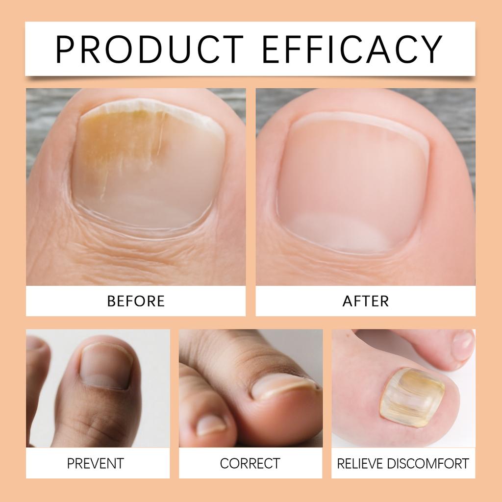 Nail Care, Nail Bed Strengthening, Toenail Growth , Nail Health Nourishment And Moisturization,10ML