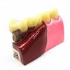1 Pc Dental Teeth Common Pathologies Model Teaching Model Tooth Dentist for Medical Science Teaching Dental Communication Model