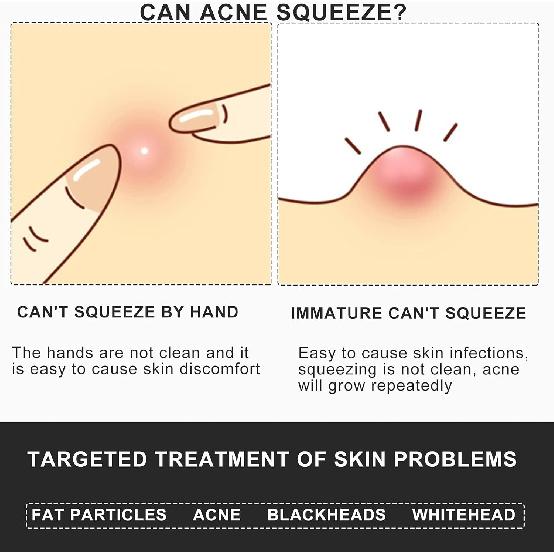 Professional Facial Milia Removal and Whitehead Extractor & Lancet - Double Ended Circle Loop & Sharp Needle Pimple Popper Tool - 2-in-1 Blackhead &