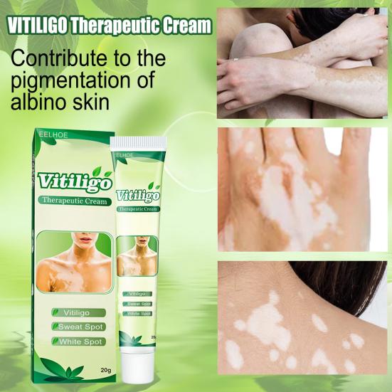 20 g White-Tag-Creme, einzigartige Verwendung von Pflanzenextrakten, therapeutische Vitiligo-Creme
