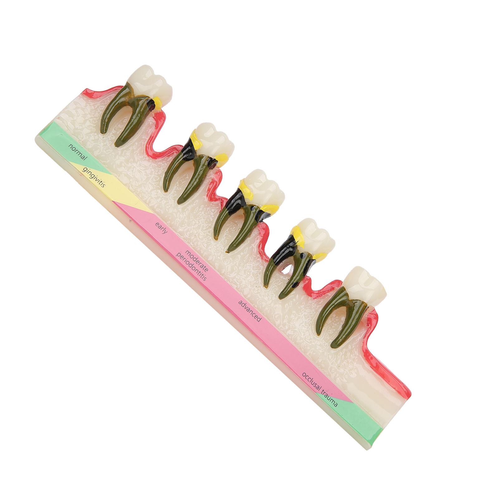 

Стоматологическая модель пародонтита Модель для изучения заболеваний зубов Учебная модель для стоматологической школы