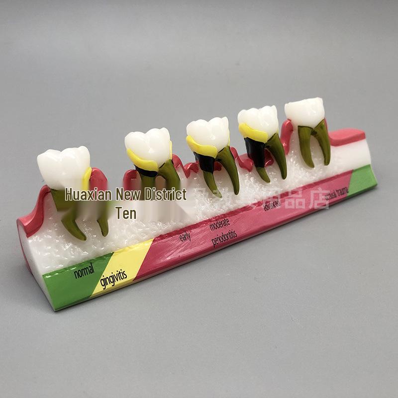 Dental Model for Periodontal Classification and Caries Process - Doctor-Patient Communication Tool M8 Gingival Periodontal Classification