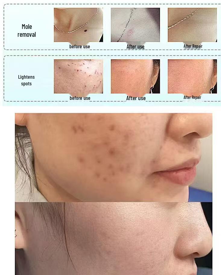 PicoSecond Laser Beauty Device for Spot, Freckle, Mole, Tattoo Removal, & Non-Invasive Brow Wash