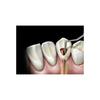 GDC Root Canal Plugger Luks -(.50mm) Rcpl2 #3