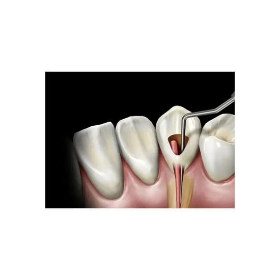 GDC Root Canal Plugger Luks -(.50mm) Rcpl2 #3