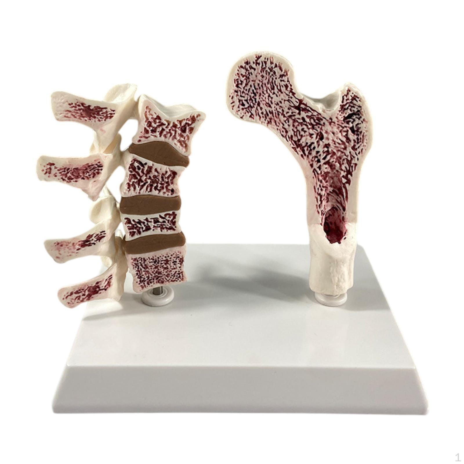 Human Femur Osteoporosis Anatomy Model Learning Props Skeleton Display Educational Tool for School