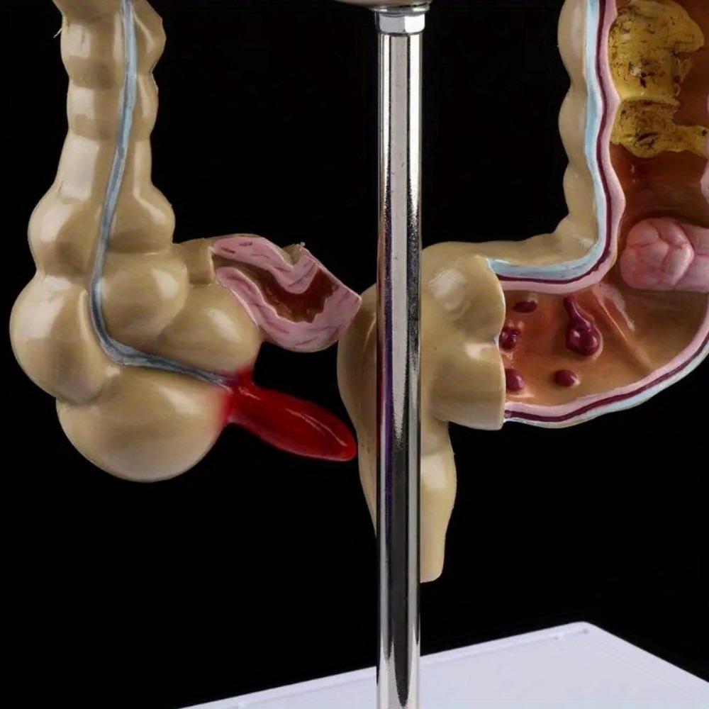 Human Colorectal Lesion Model Pathological Anatomy Colon Diseases Intestine Medical Teaching Learning Tool