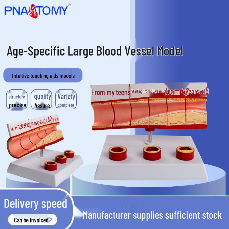 4-Part Large Blood Vessel Model - Atherosclerotic Cardiovascular Artery Pathology 20.5 x 14 x 13.5 cm