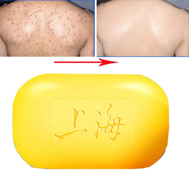 acne control soap
