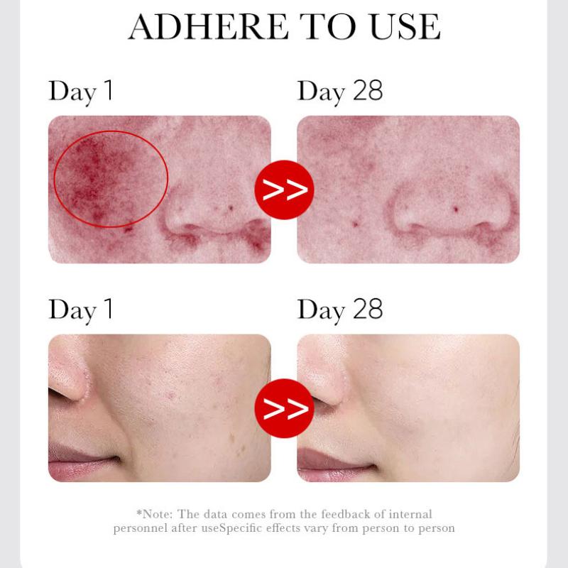 Acne Serum SADOER Fruit Acid Dilutes Acne Marks, Hydrates and Moisturizes