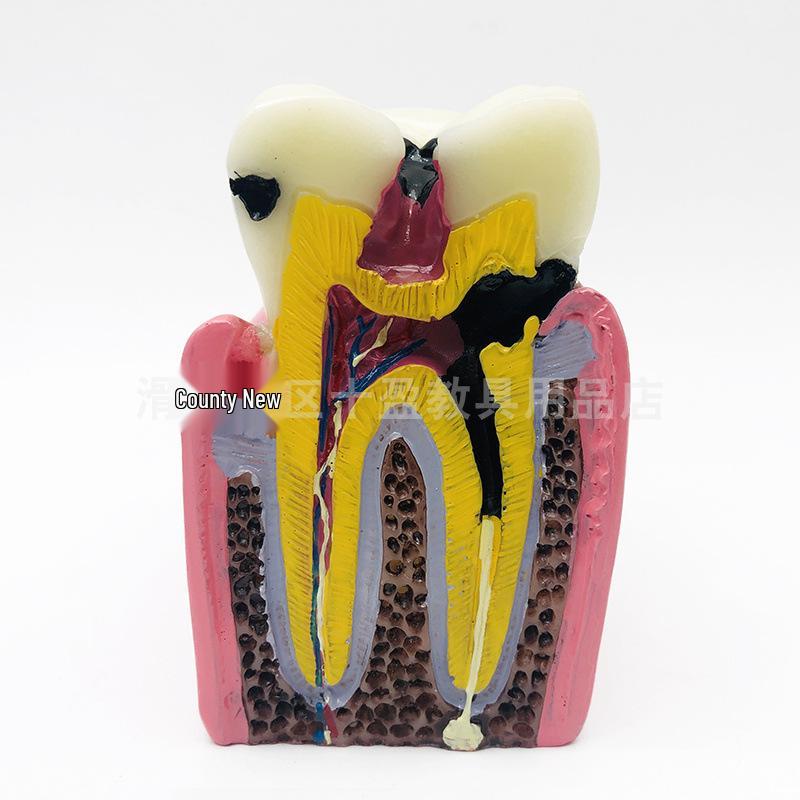 6x Oral Caries Comparison Model - Dental Teaching Aid 6x