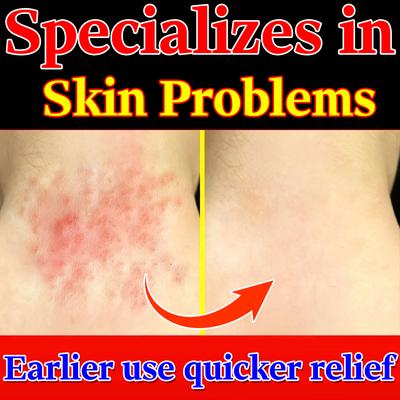 Natürliche Hautproblem-Linderungscreme - Lindert Ekzeme, Dermatitis & Juckende Haut