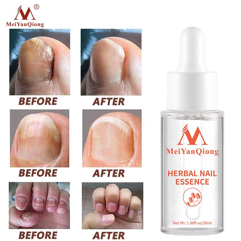 Herbal Nail Treatment Essential Oil Hand and Foot Whitening Toe Nail Removal Feet Care Polish Nail Gel Nail Repair Treatment