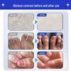 Baibang Qiling Nail Fungus Treatment