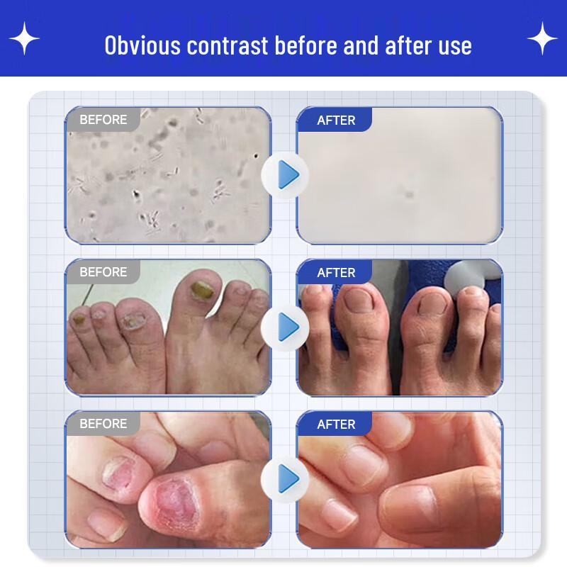 Baibang Qiling Nail Fungus Treatment