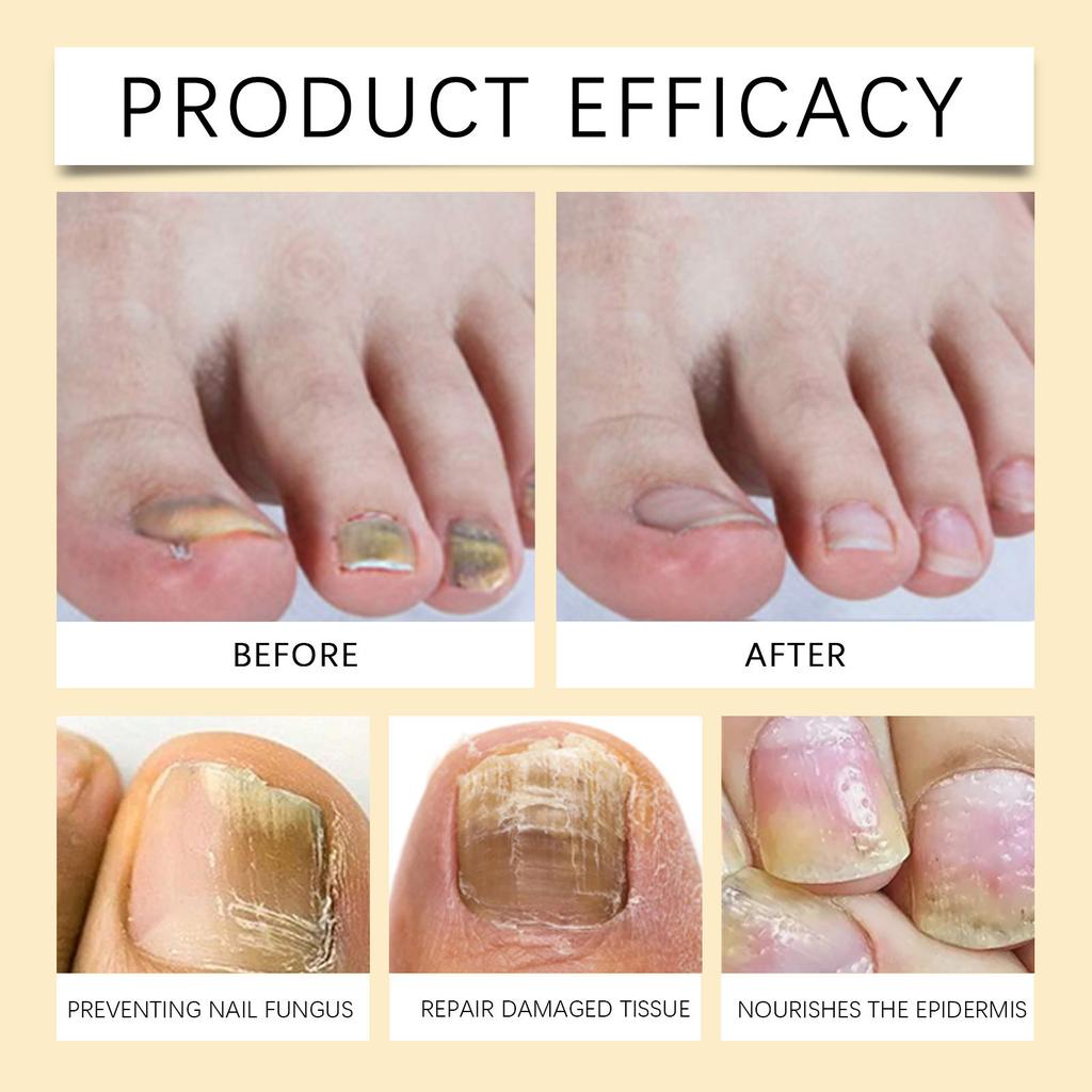 Bee Nail Liquid Special Liquid Nail Care Liquid Soft Nail Paste Nail Care Nail Care Onychomycosis Liquid8ml